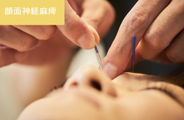 顔面神経麻痺の鍼灸